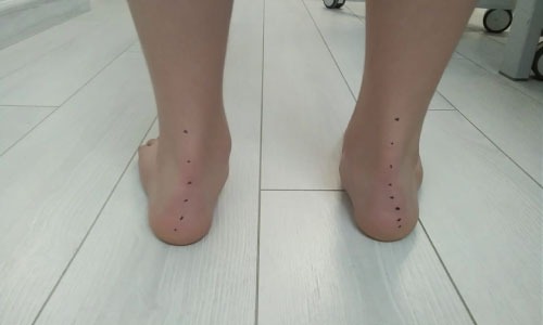 Flat Foot Physiotherapy